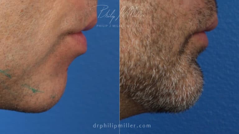 Chin implant to augment chin and define the jawline by Dr. Miller