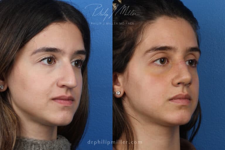 Rhinoplasty to remove hump from nasal bridge, one week later, by Dr. Miller
