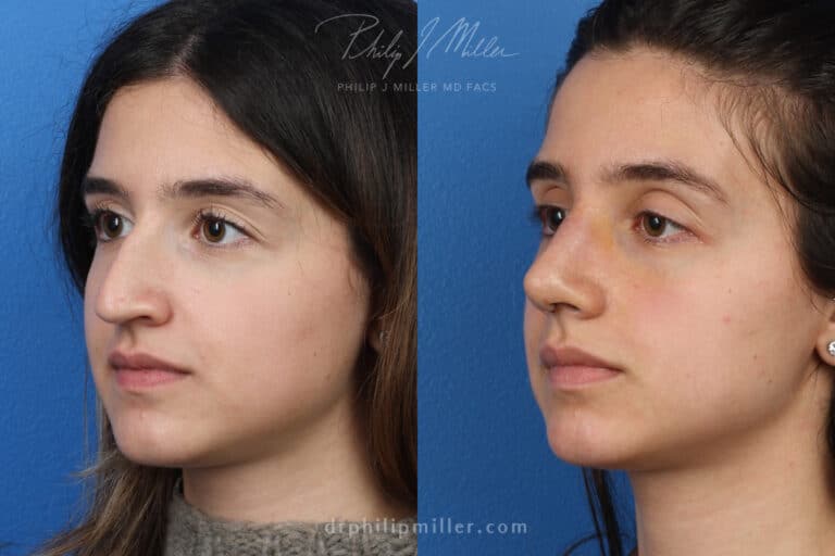 Rhinoplasty to remove hump from nasal bridge, one week later, by Dr. Miller