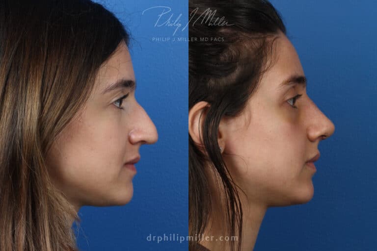 Rhinoplasty to remove hump from nasal bridge, one week later, by Dr. Miller