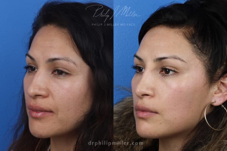 Rhinoplasty to remove hump from nasal bridge and refine tip by Dr. Miller