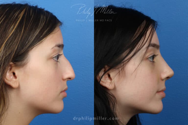 Rhinoplasty to straighten nasal bridge and rotate tip, one week post-op by Dr. Miller