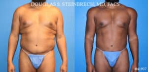 body contouring treatment results in NYC, NY