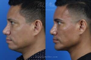 neck tite body contouring results in NY, NY