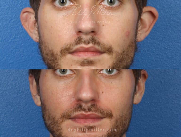 Otoplasty to correct the ear position of a male patient by Dr. Miller