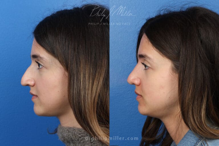 Rhinoplasty to remove hump from nasal bridge, three months later, by Dr. Miller