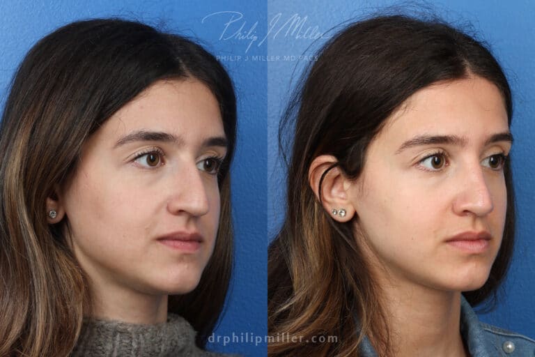 Rhinoplasty to remove hump from nasal bridge, three months later, by Dr. Miller