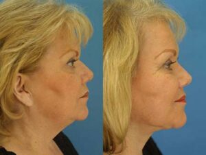 facelift before and after results included in blog about signs of plastic surgery in NYC