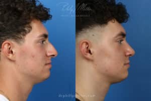 rhinoplasty before and after results included in blog about signs of plastic surgery in New York City