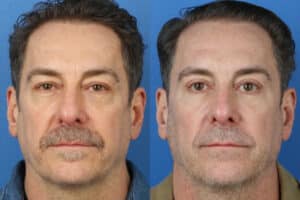 blepharoplasty before and after results included in blog about signs of plastic surgery in NY, NY