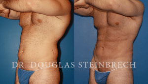 liposuction before and after results included in blog about signs of plastic surgery in NYC