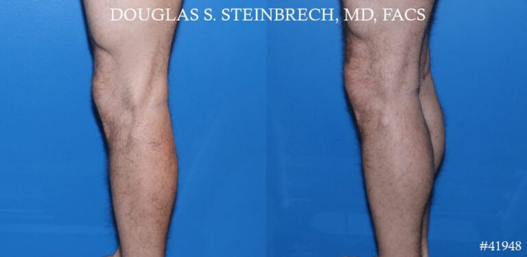 Calf implants to augment the lower leg by Dr. Steinbrech