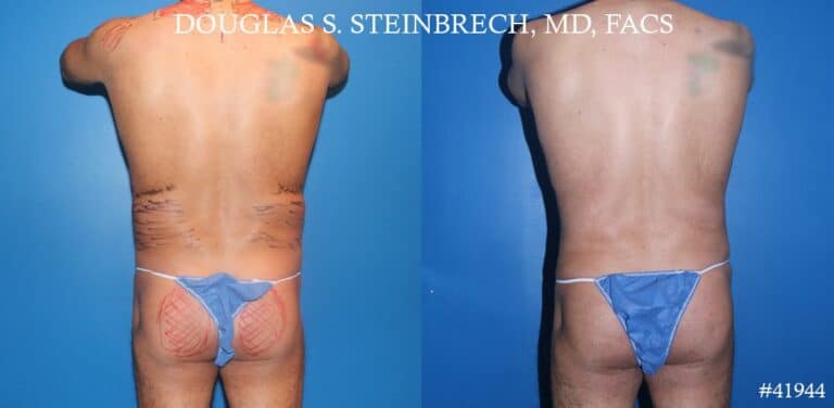 Liposuction with body banking to augment pecs and glutes by Dr. Steinbrech