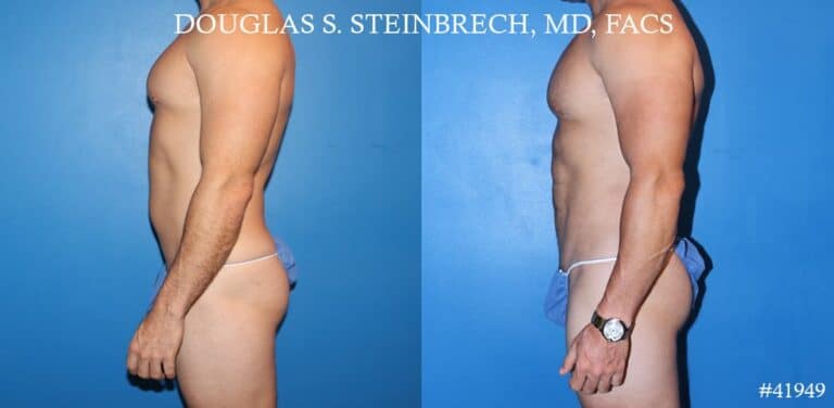 Liposuction and body banking to sculpt midsection, augment pecs and shoulders by Dr. Steinbrech