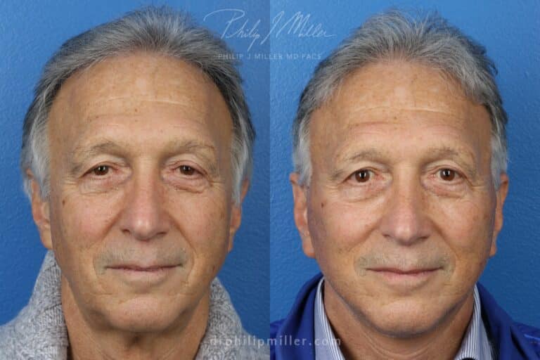 Neck lift to rejuvenate the neck and jawline by Dr. Miller