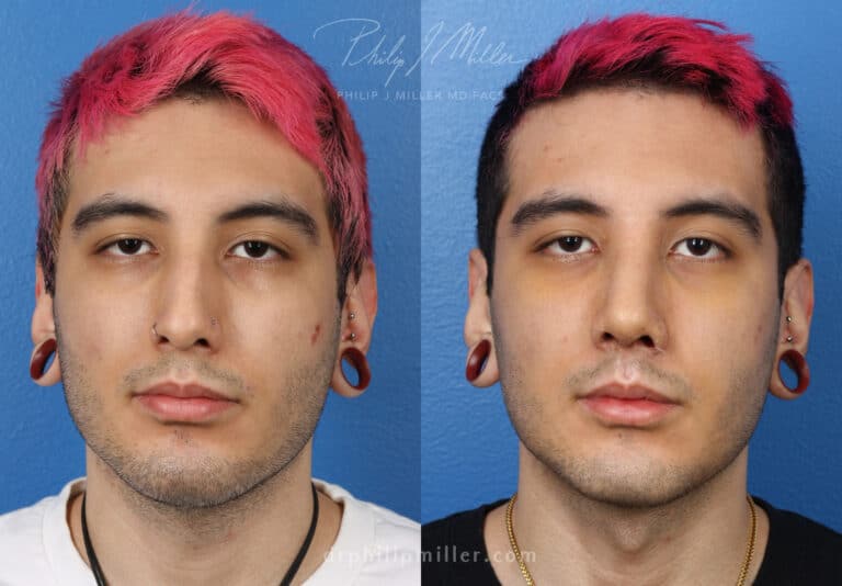 Rhinoplasty to improve the contour of the nose by Dr. Miller
