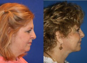 facelift surgery results to reduce sagging jowls in NYC