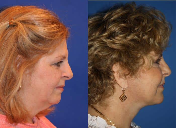 5 Fixes for a Sagging Chin - Cosmetic Laser Dermatology Skin Specialists in  San Diego