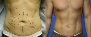 liposuction procedure results in NYC, NY