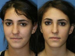 revision rhinoplasty results in NY, NY