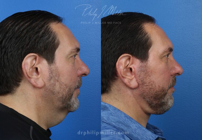 Facelift and neck lift to rejuvenate the appearance of a male patient by Dr. Miller