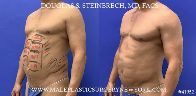 Liposuction with body banking to augment the abs by Dr. Steinbrech.