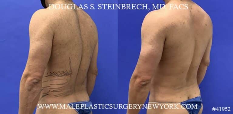 Liposuction with body banking to augment the abs by Dr. Steinbrech.