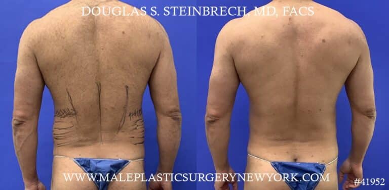Liposuction with body banking to augment the abs by Dr. Steinbrech.