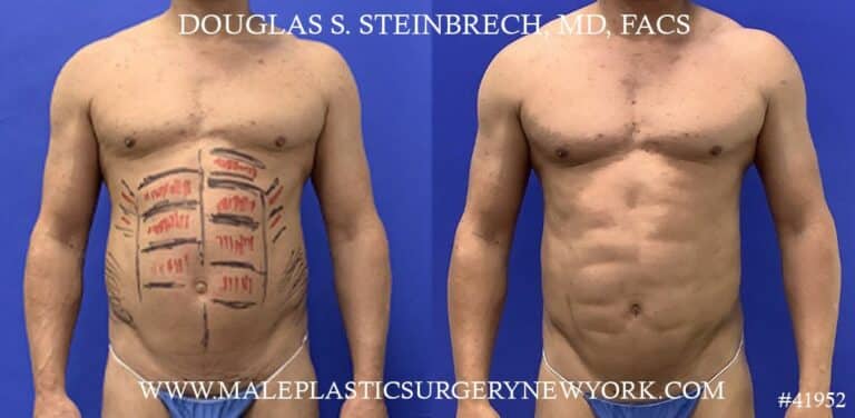 Liposuction with body banking to augment the abs by Dr. Steinbrech.