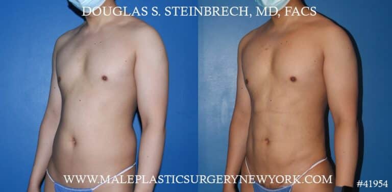 Liposuction with body banking to augment the pecs and shoulders by Dr. Steinbrech