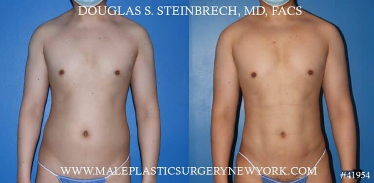Liposuction with body banking to augment the pecs and shoulders by Dr. Steinbrech