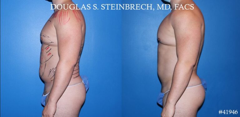 Liposuction with body banking to enhance the pecs and glutes by Dr. Steinbrech.