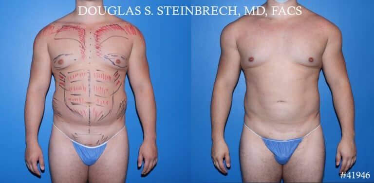 Liposuction with body banking to enhance the pecs and glutes by Dr. Steinbrech.