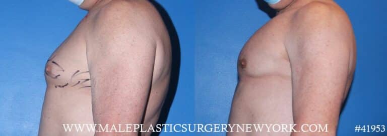 Pectoral implants to add definition to the chest by Dr. Steinbrech.