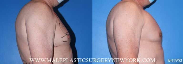 Pectoral implants to add definition to the chest by Dr. Steinbrech
