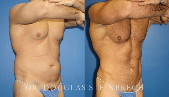 Tummy Tuck Surgery: Let's Talk about Scarring - Signature Plastic