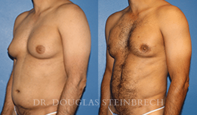 Increase apparent penile length by cryolipolysis in the reduction