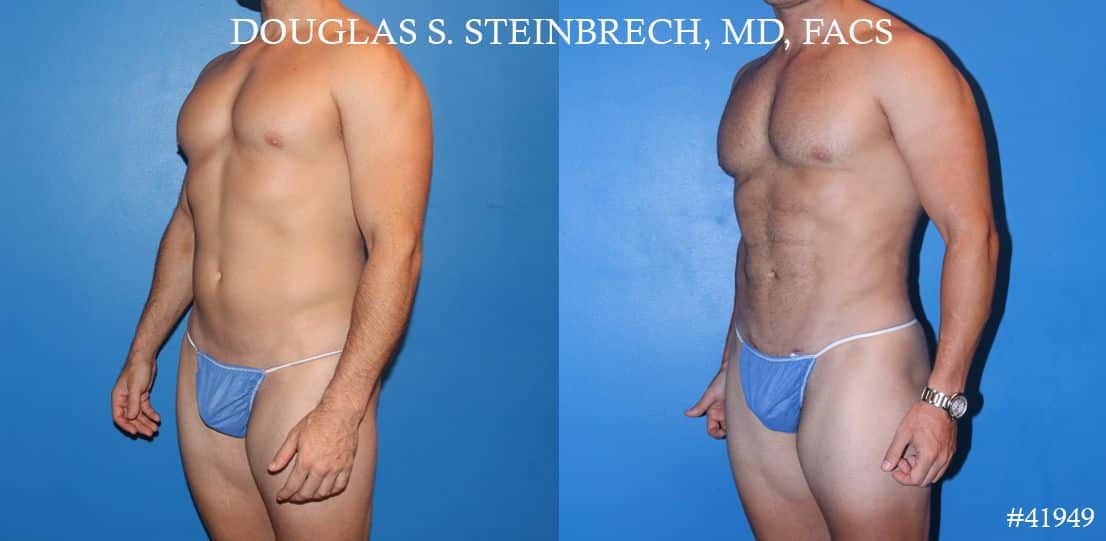 Men attracted to plastic surgery, from 'torso tucks to hair