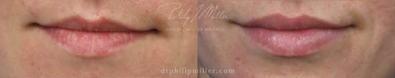 Filler to enhance the shape and volume of the lips by Dr. Miller