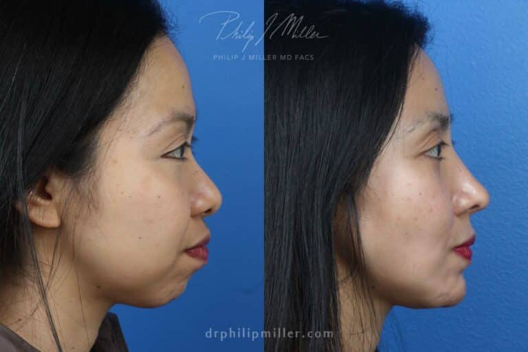 Rhinoplasty, chin implant, and fat grafting for facial enhancement by Dr. Miller