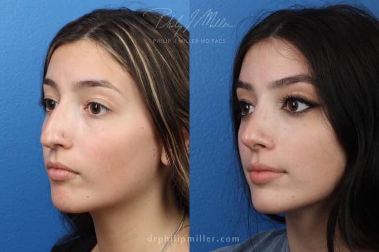 Rhinoplasty to remove nasal hump and refine tip by Dr. Miller