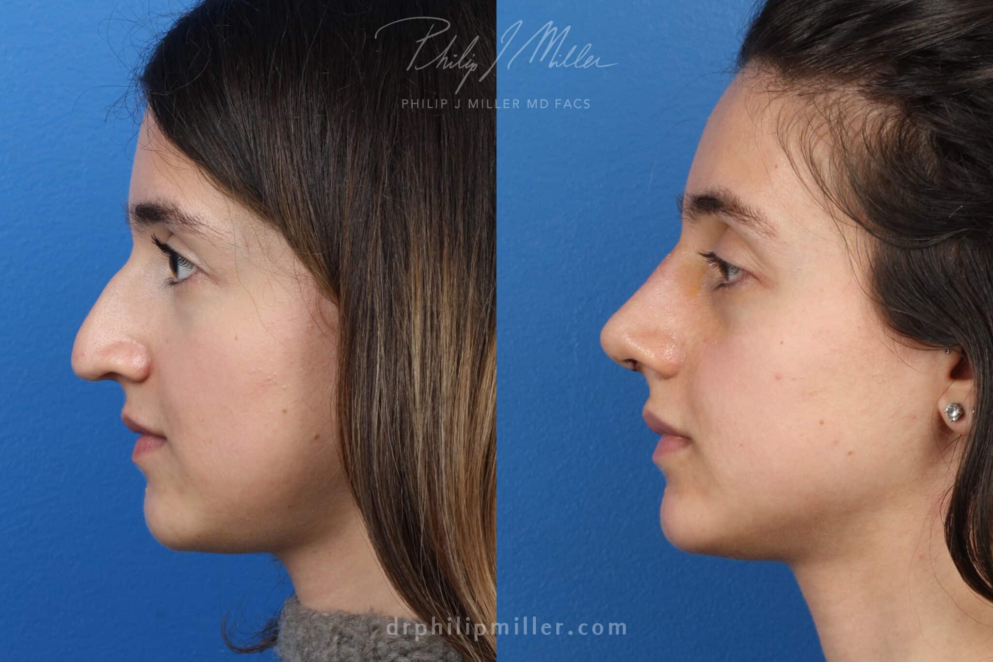 The Non-Invasive Facelift for that Perfectly Sculpted Jaw - Cutera  Aesthetics