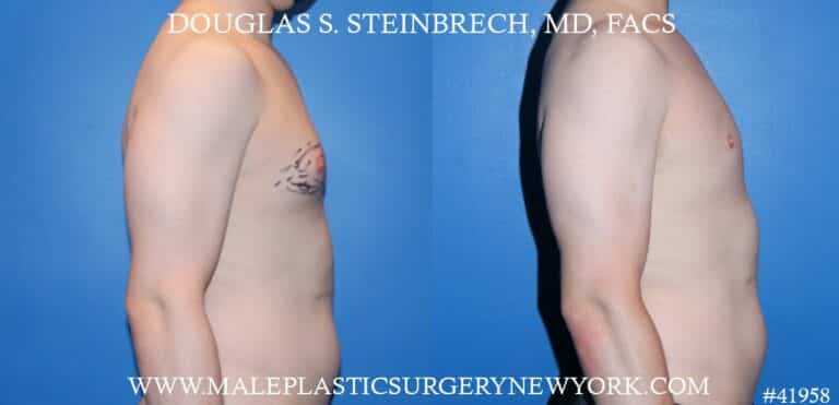 Gynecomastia treatment to enhance the appearance of the chest by Dr. Steinbrech