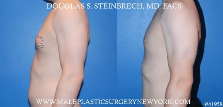 Gynecomastia treatment to enhance the appearance of the chest by Dr. Steinbrech