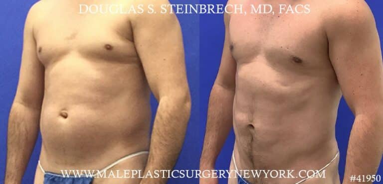 Gynecomastia treatment to reduce the male chest by Dr. Steinbrech