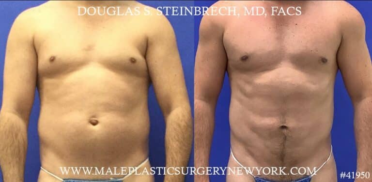 Gynecomastia treatment to reduce the male chest by Dr. Steinbrech