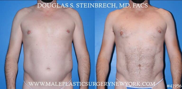 Liposuction with body banking to augment the pecs by Dr. Steinbrech