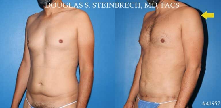 270° Torso Tuck with Body Banking to Pecs and Shoulders by Dr. Steinbrech
