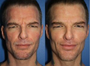 before and after results from Botox injections in NYC, NY