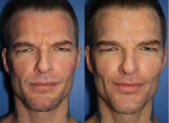 Midface Lift in New York City - Philip Miller MD